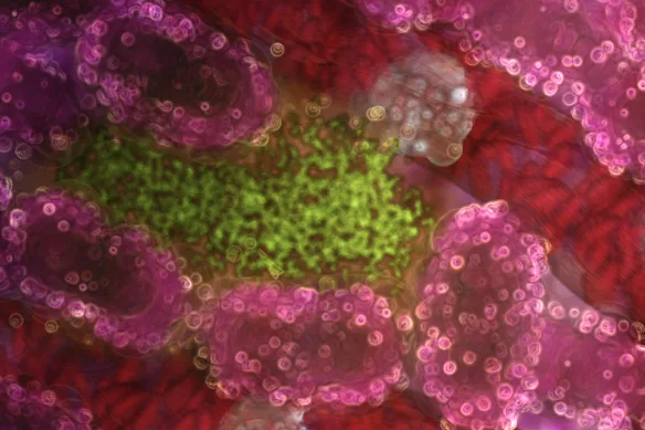 Illustration of liver cells (pink) infected with a malaria parasite (green). Malaria lurks and multiplies in the liver before attacking red blood cells.