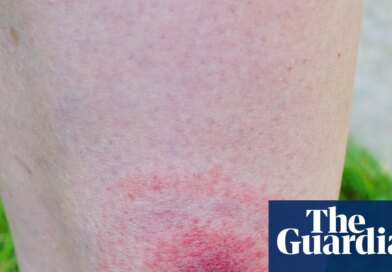 Lyme disease cases in England rise by more than 20% in a year | Lyme disease