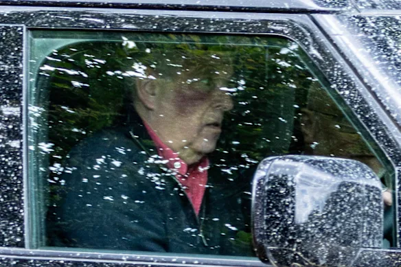 Andrew Mountbatten-Windsor has been spotted driving with a large bruise on his right cheek.